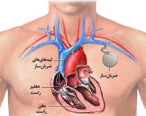 عکس ضربان ساز- پزشکت