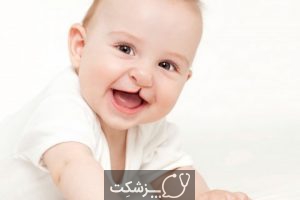 لب شکری (شکاف کام و لب) | پزشکت