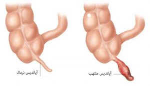 آپاندیسیت | پزشکت