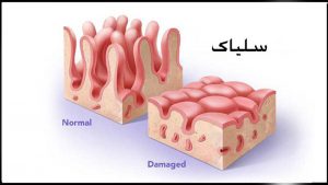 بیماری سلیاک | پزشکت