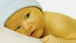 زردی نوزاد | پزشکت