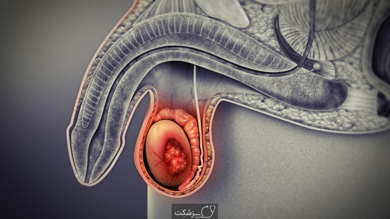 سرطان بیضه | پزشکت