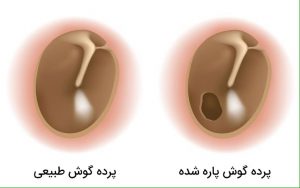 پارگی پرده گوش | پزشکت