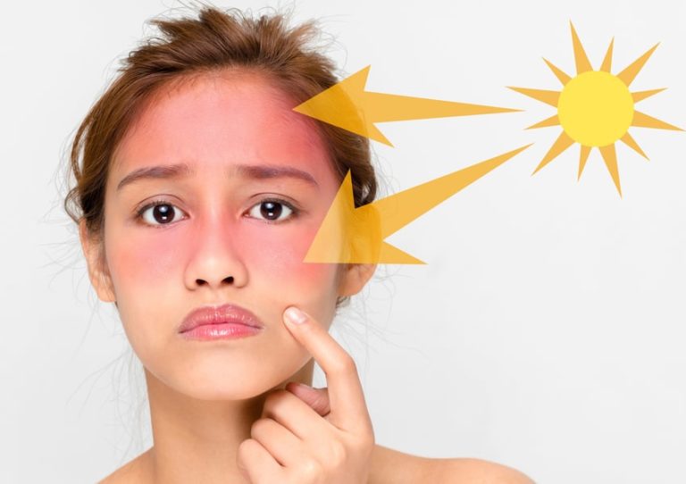 آفتاب سوختگی | پزشکت