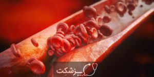 آترواسکلروز | پرشکت