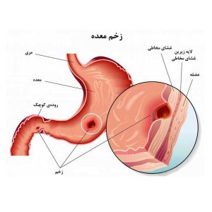 زخم معده | پزشکت