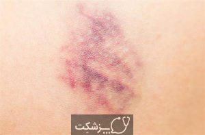 کدام ویتامین در انعقاد خون نقش دارد