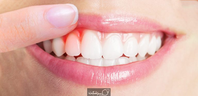 التهاب لثه | پزشکت