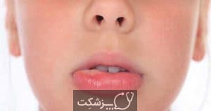 آفت دهان | پزشکت