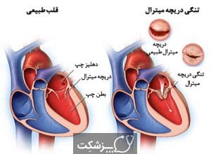 تنگی دریچه میترال | پزشکت