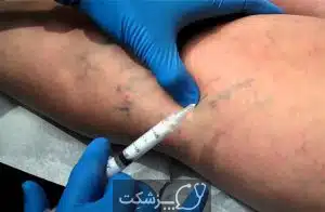 رگ های واریس | پزشکت