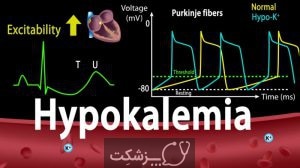 هیپوکالمی | پزشکت