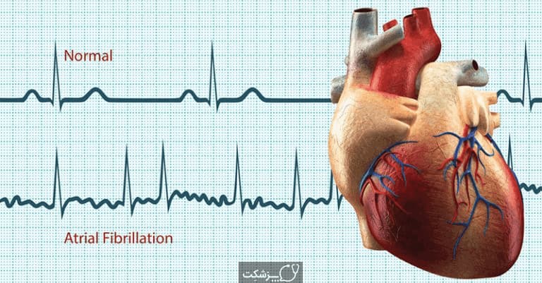 فیبریلاسیون دهلیزی | پزشکت