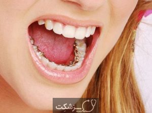 بریس های پشت دندانی | پزشکت