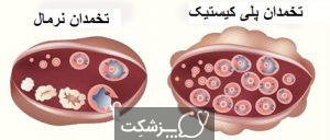 سندروم تخمدان پلی کیستیک | پزشکت