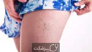 رگ های واریس | پزشکت