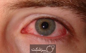جراحی چشم لیزیک | پزشکت