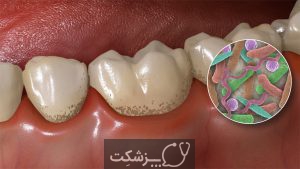 جرم دندان | پزشکت