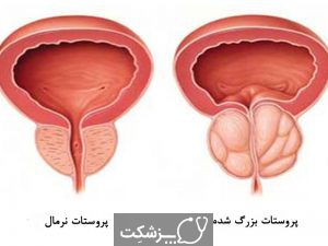 سرطان پروستات | پزشکت