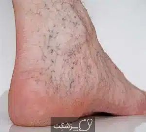 رگ های واریس | پزشکت