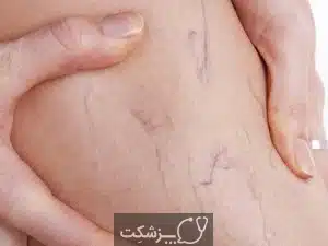رگ های واریس | پزشکت