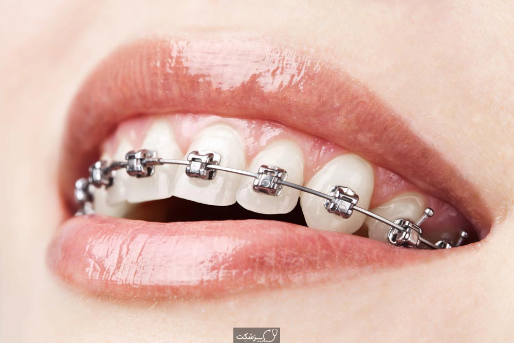بریس (مکانیزم هدایت صحیح دندان) | پزشکت