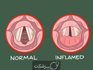 التهاب حنجره | پزشکت