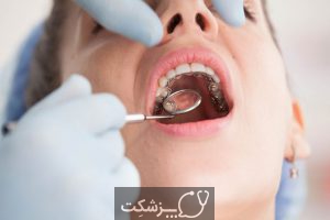 بریس های پشت دندانی | پزشکت