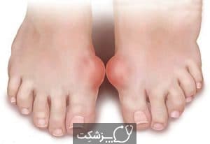 نقرس | پزشکت