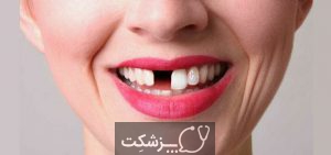 جایگزینی دندان های از دست رفته | پزشکت