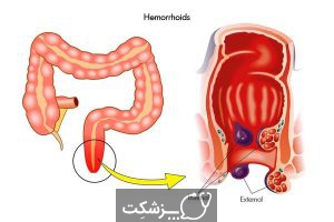 بواسیر در کودکان | پزشکت