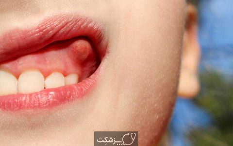 عفونت دندان | پزشکت