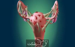 آندومتریوز | پزشکت