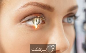 گلوکوما چشم (آب سیاه) | پزشکت