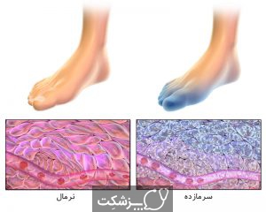 سرمازدگی | پزشکت