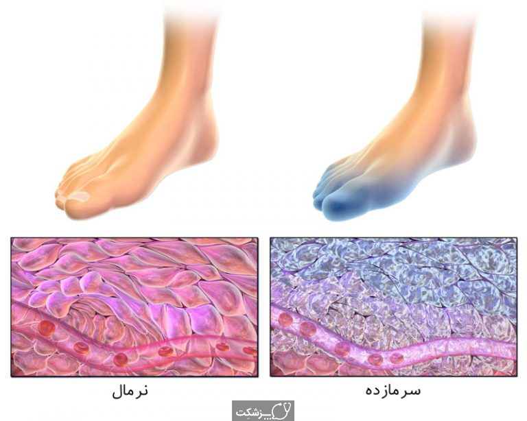 سرمازدگی | پزشکت
