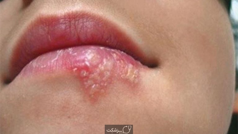 نحوه تسکین درد تبخال با داروهای خانگی | پزشکت