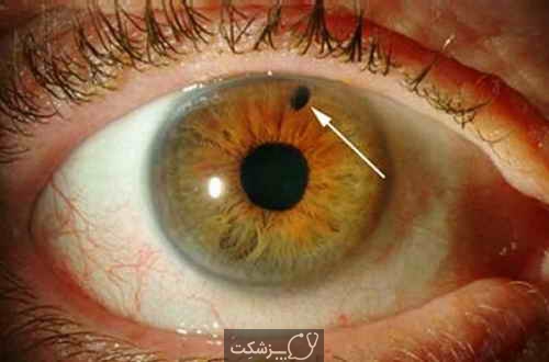 گلوکوما چشم (آب سیاه)