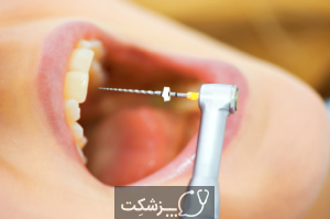 تورم لثه در اطراف دندان | پزشکت