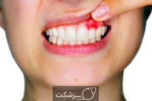 عفونت دندان | پزشکت