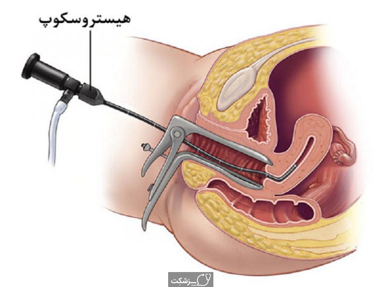 هیستروسکوپی | پزشکت