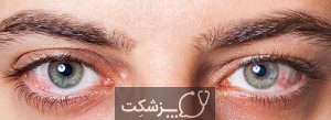 خشکی چشم | پزشکت