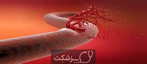 خون ریزی داخلی | پزشکت