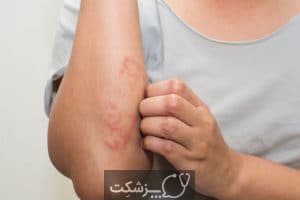 اگزما | پزشکت