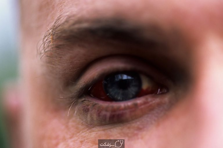 شایع ترین عوارض دیابت درمان نشده | پزشکت