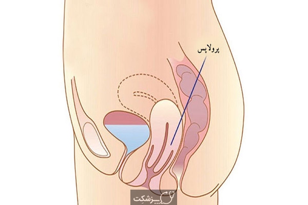 پرولاپس دیواره خلفی واژن (رکتوسل) | پزشکت