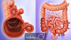 مدفوع خونی | پزشکت