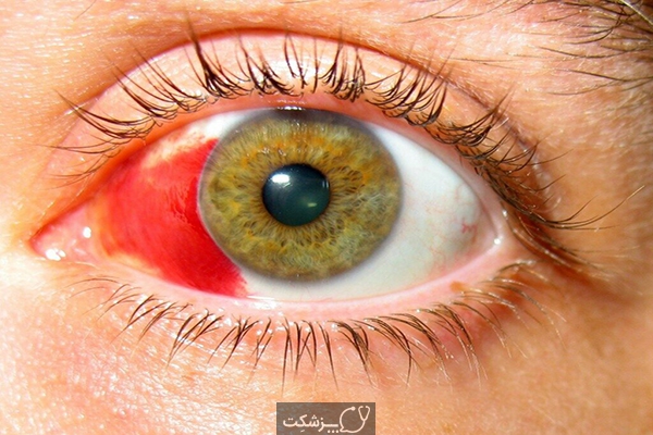 بیماری کولوبوم چشمی | پزشکت