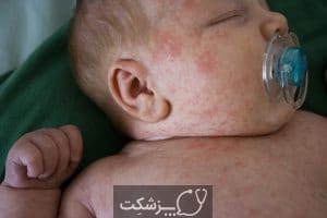 عرق سوز یا عرق گز | پزشکت