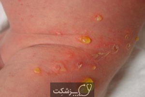 بیماری پوستی زرد زخم | پزشکت